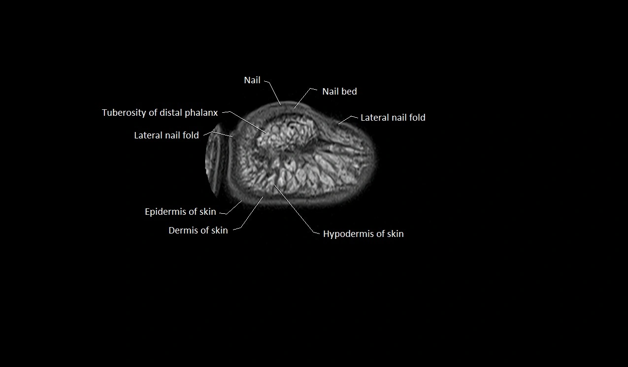 Great toe (hallux) axial microanatomy 3T MRI image 4.webp